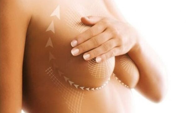 elevação de sutura para aumento de mama