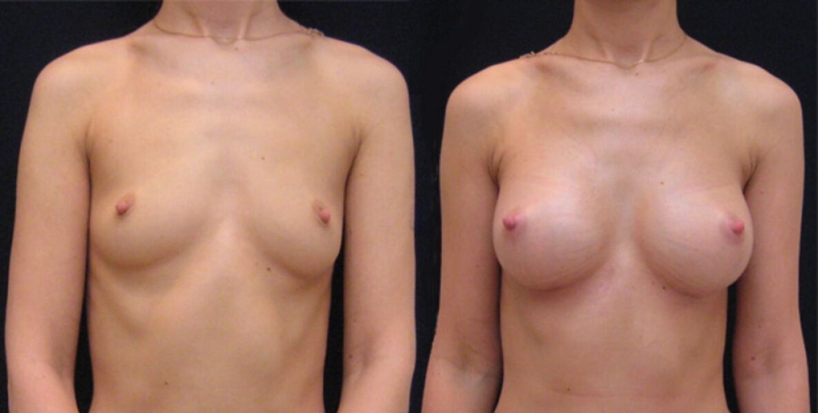 mama antes e depois do aumento endoscópico