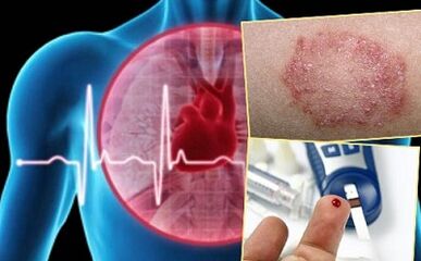 Contra -indicações para lipolifting