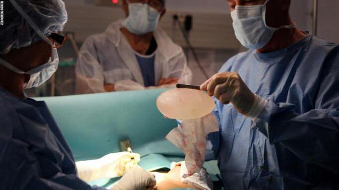 Características da mamoplastia