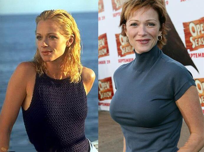 antes e depois da mamoplastia