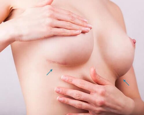 Aumento de mama com implantes