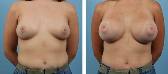 fotos antes e depois do aumento dos seios