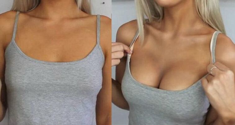 Antes e depois do aumento dos seios