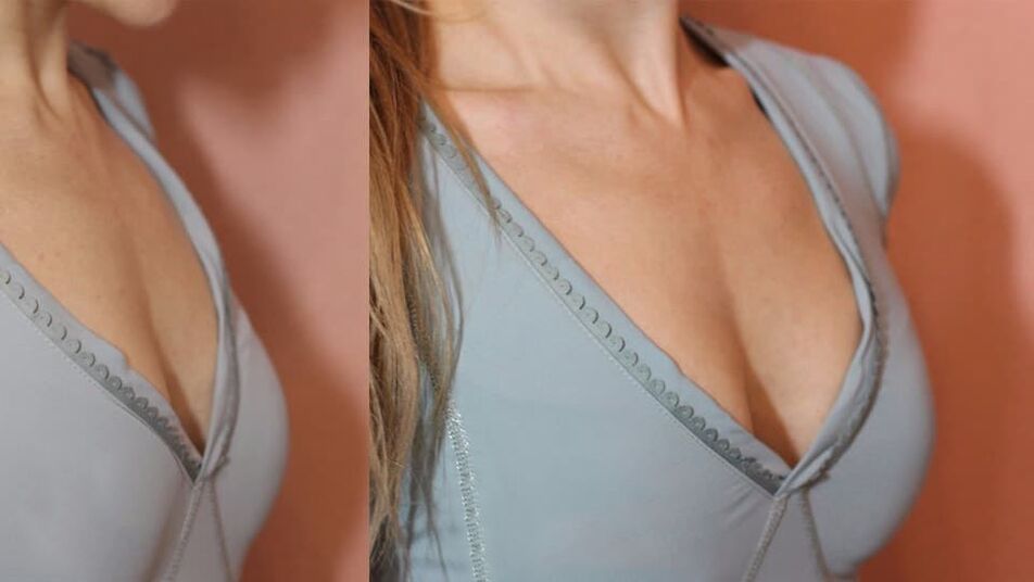 antes e depois dos produtos para aumentar os seios