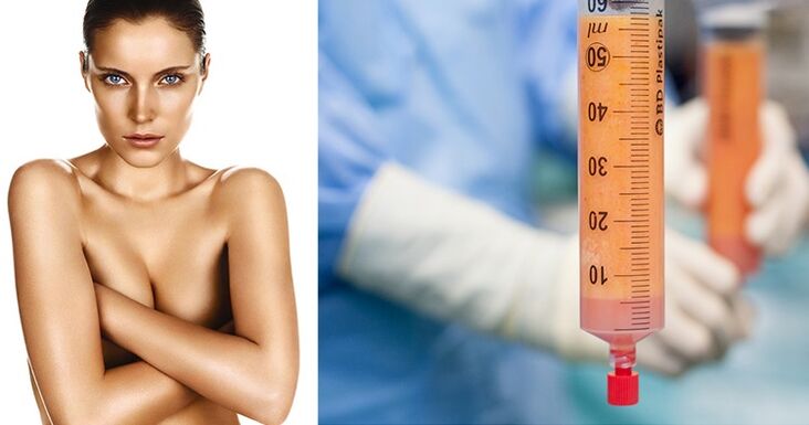 lipofilling como método de aumento dos seios
